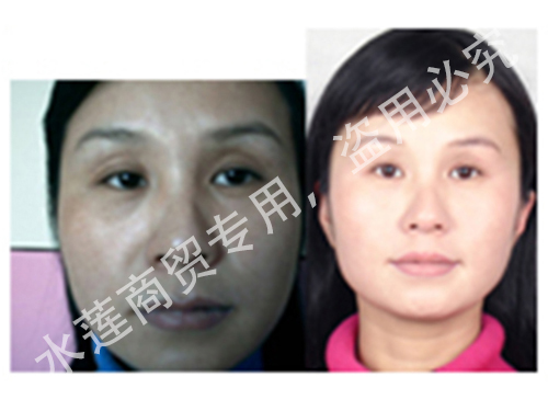 混合斑治療前后